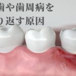 昔治療した歯がまた虫歯になる理由