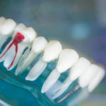 歯の神経を取った後の歯はどうなっていくのですか？