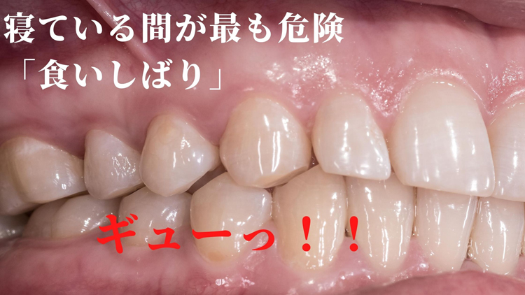 歯の根まで割れている歯は抜歯になるのか？｜香川県高松市の歯を抜かない治療なら吉本歯科医院