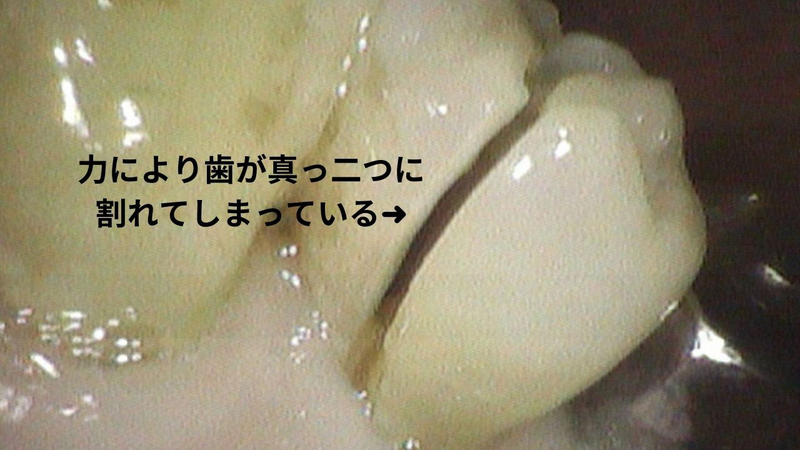 歯の根まで割れている歯は抜歯になるのか？｜香川県高松市の歯を抜かない治療なら吉本歯科医院