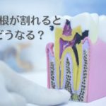 意外に多い歯が中から割れる歯根破折とは？｜抜歯しない治療なら香川県高松市の吉本歯科医院