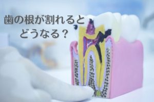 意外に多い歯が中から割れる歯根破折とは？｜抜歯しない治療なら香川県高松市の吉本歯科医院