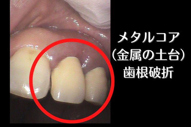 メタルコア（金属の土台）の歯根破折｜香川県高松市の吉本歯科医院