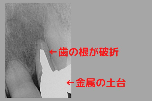 金属の土台が割れて歯根破折｜歯を抜かない治療なら高松市の吉本歯科医院