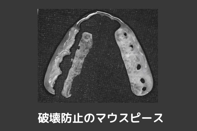 メタルコア（金属の土台）の歯根破折｜香川県高松市の吉本歯科医院